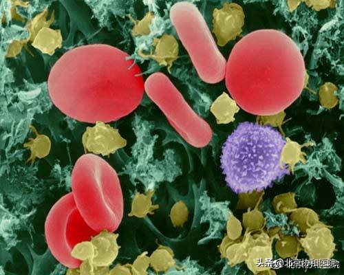 胰腺癌新辅助化疗方案,协和治胰腺癌粒子植入存活6年
