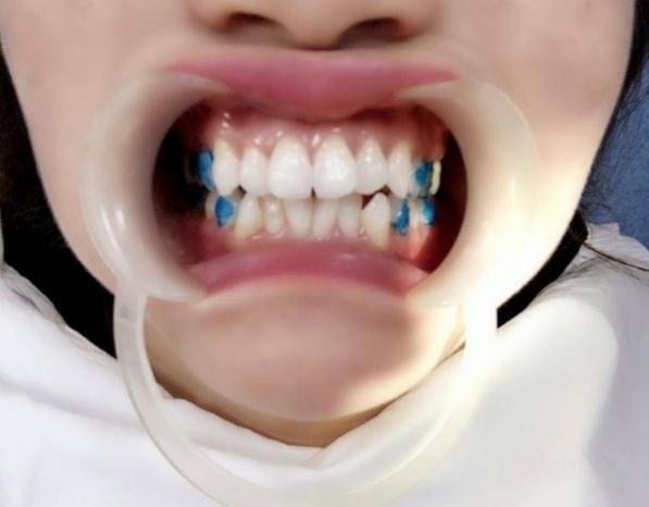 时代天使隐形牙套价格,时代天使隐形牙套能不能戴着吃饭