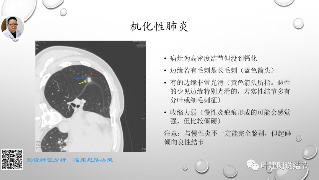 叶建明谈肺实性小结节视频,廖正银教授谈肺结节
