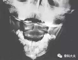 脖子突然往一边歪是怎么回事,孩子脖子突然歪了怎样矫正