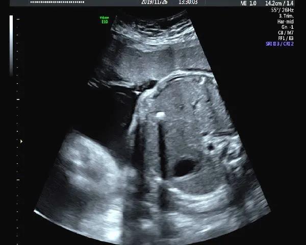 胎儿超声强回声,胎儿超声超细讲解视频