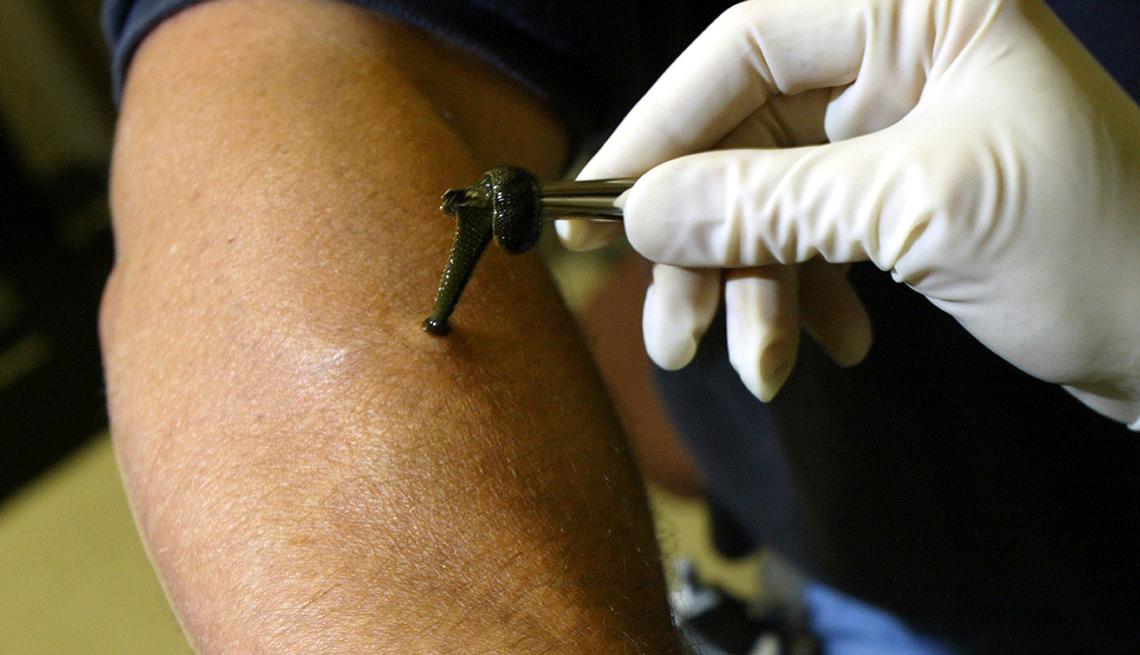 男孩被蚂蚁吓死,蚂蝗寄生在五岁男孩身体里一年