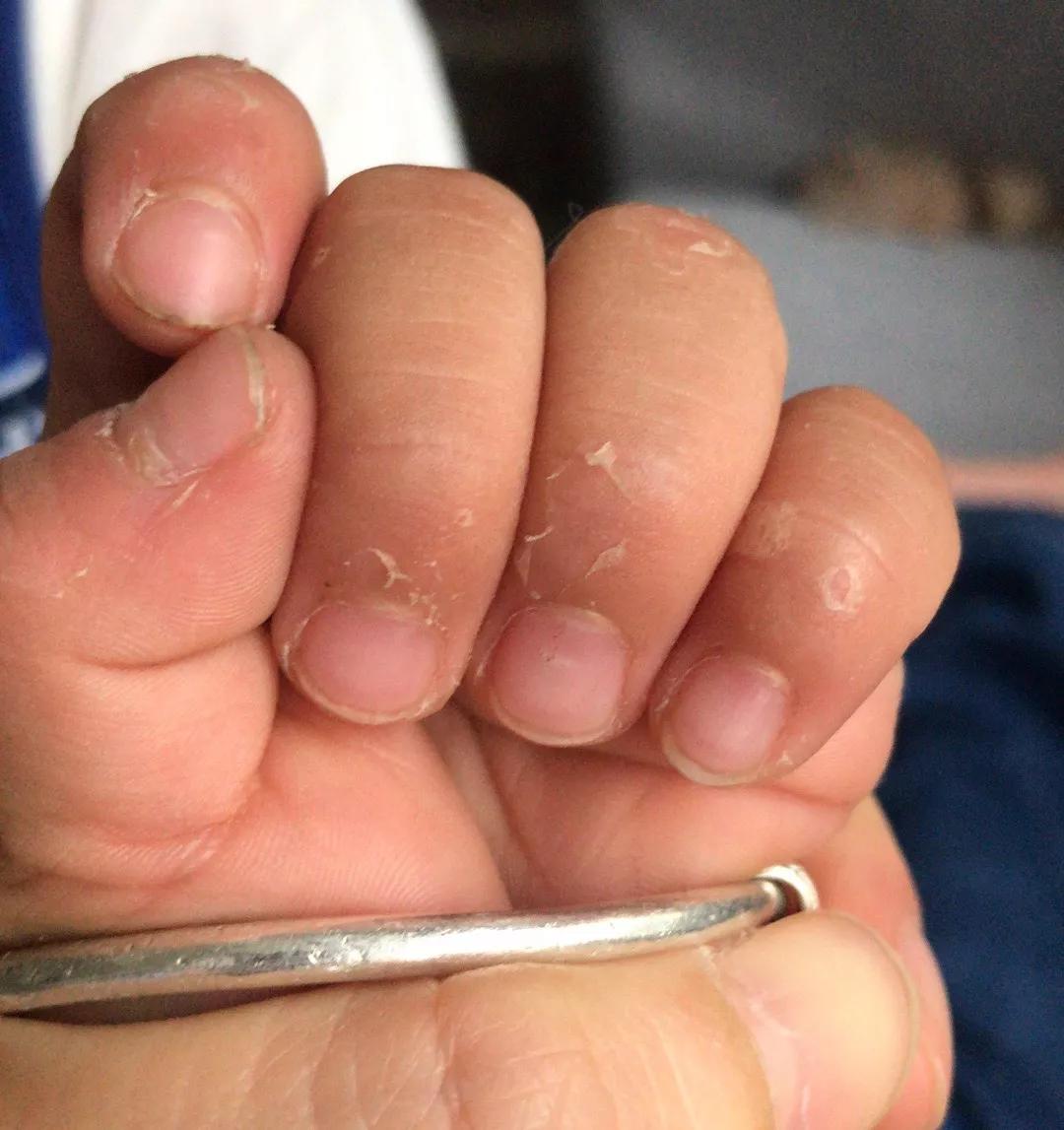 手上脱皮是什么真菌,手上脱皮真菌感染抹什么药膏好