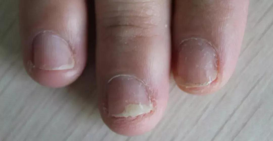 「科普」指甲型银屑病与灰指甲的区别