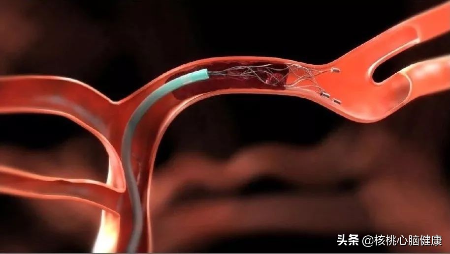 脑梗一年要打几次疏通血管的针,脑梗疏通血管最佳方法