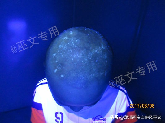 白癜风黑色素培植手术复发率高吗,黑色素种植术治疗白癜风的全过程