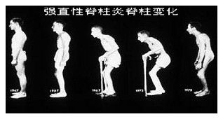 弯腰时腰部有压迫感是腰突吗,弯腰久了背后疼痛是什么病