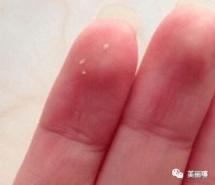 嘴巴下巴长了许多小白点怎么处理,嘴巴下巴长了许多小颗粒怎么去除