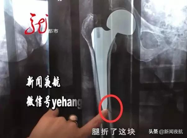 80岁老人股骨置换术后怎样做护理,80岁老人股骨头置换术后恢复