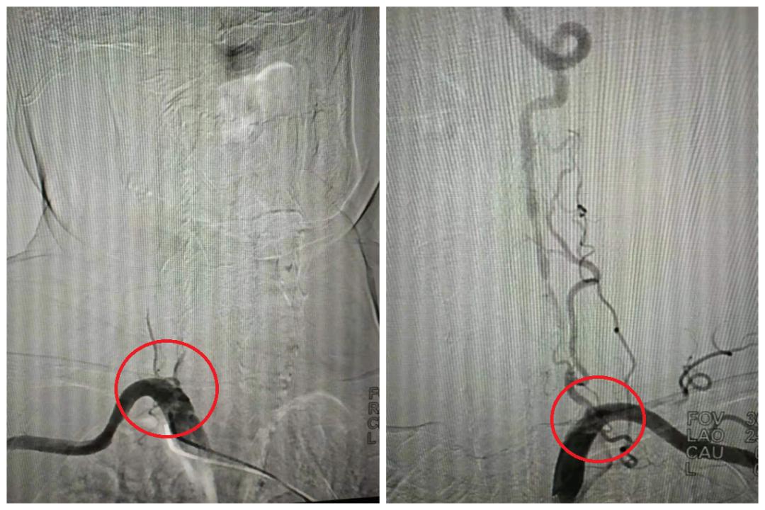 75岁老人多发性脑梗死，DSA介入治疗打通大脑“生命线”