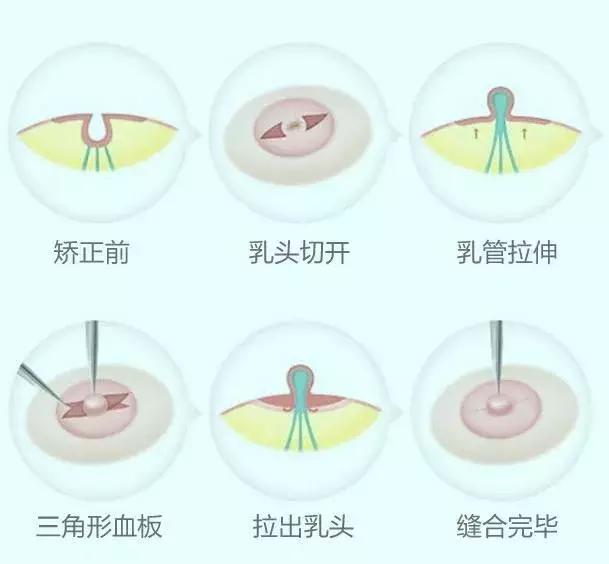 乳头内陷如何进行日常护理,乳头内陷是遗传问题还是发育问题