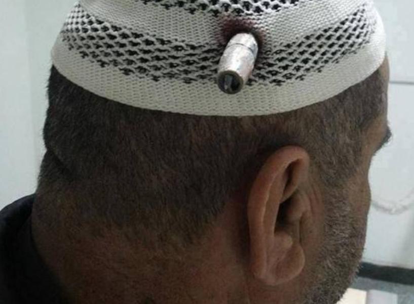 为什么头部中弹立马倒下,被骨头卡住了几小时会死