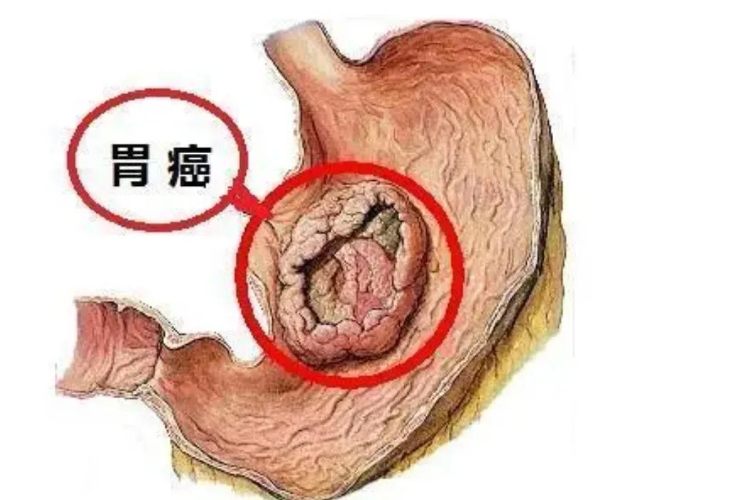 39岁女人胃癌晚期,40岁女人胃癌晚期症状