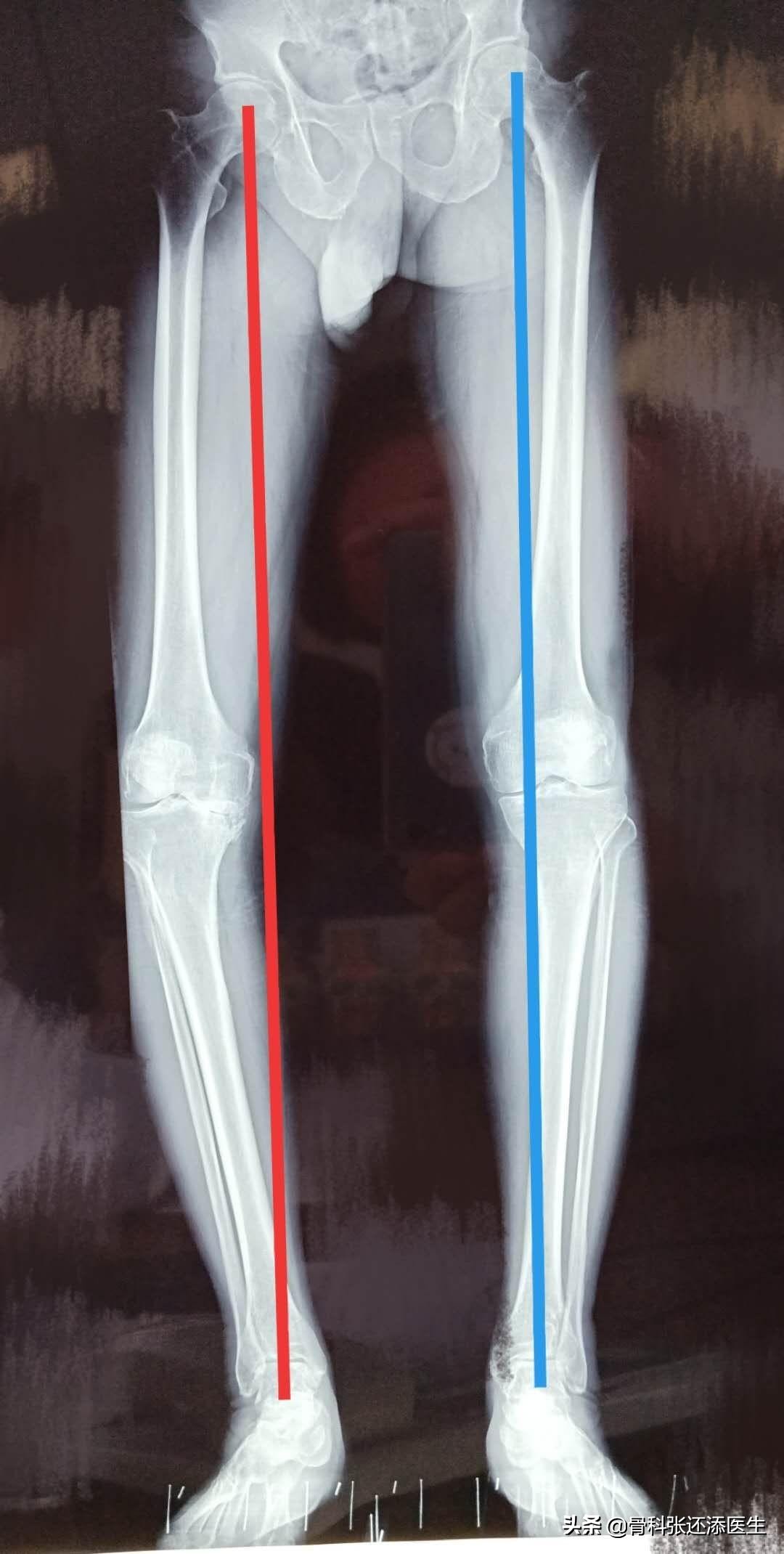 膝关节咔咔响的治疗方法,走路膝关节咔咔咔响是怎样的