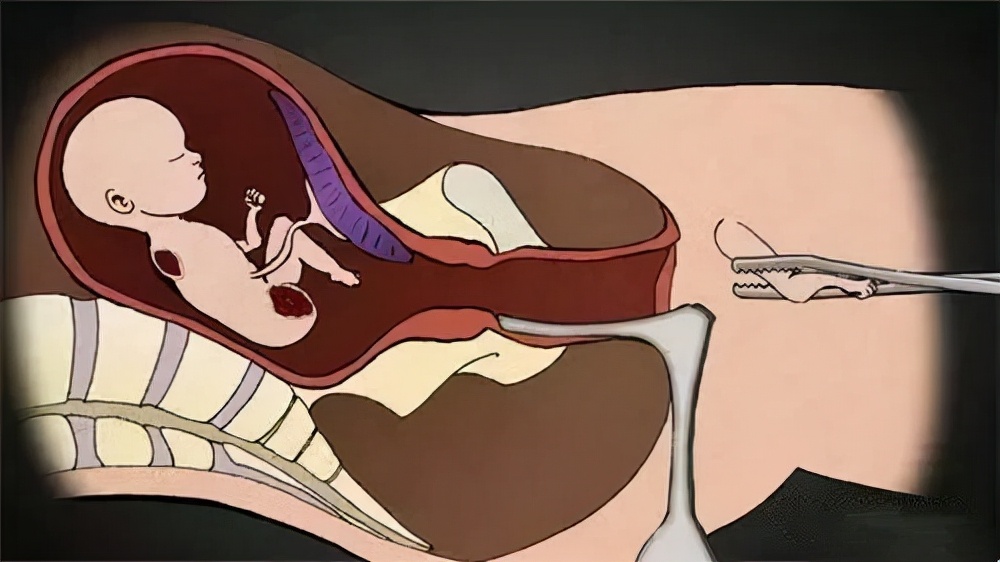 人流看妇科还是产科,人流药流哪个痛苦少