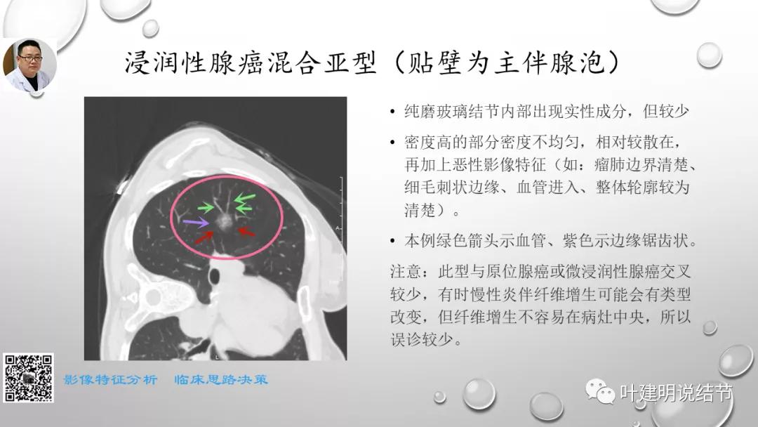 叶建明谈肺实性小结节视频,廖正银教授谈肺结节