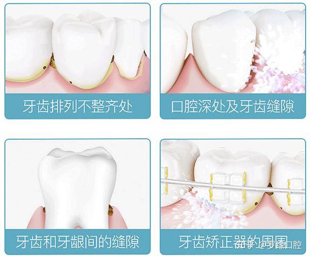 用冲牙器会把托槽冲掉吗,戴托槽牙套饭后只用冲牙器可以吗