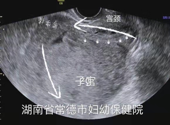 孕妇尿潴留怎么治疗才能断根,孕妇非梗阻性尿潴留