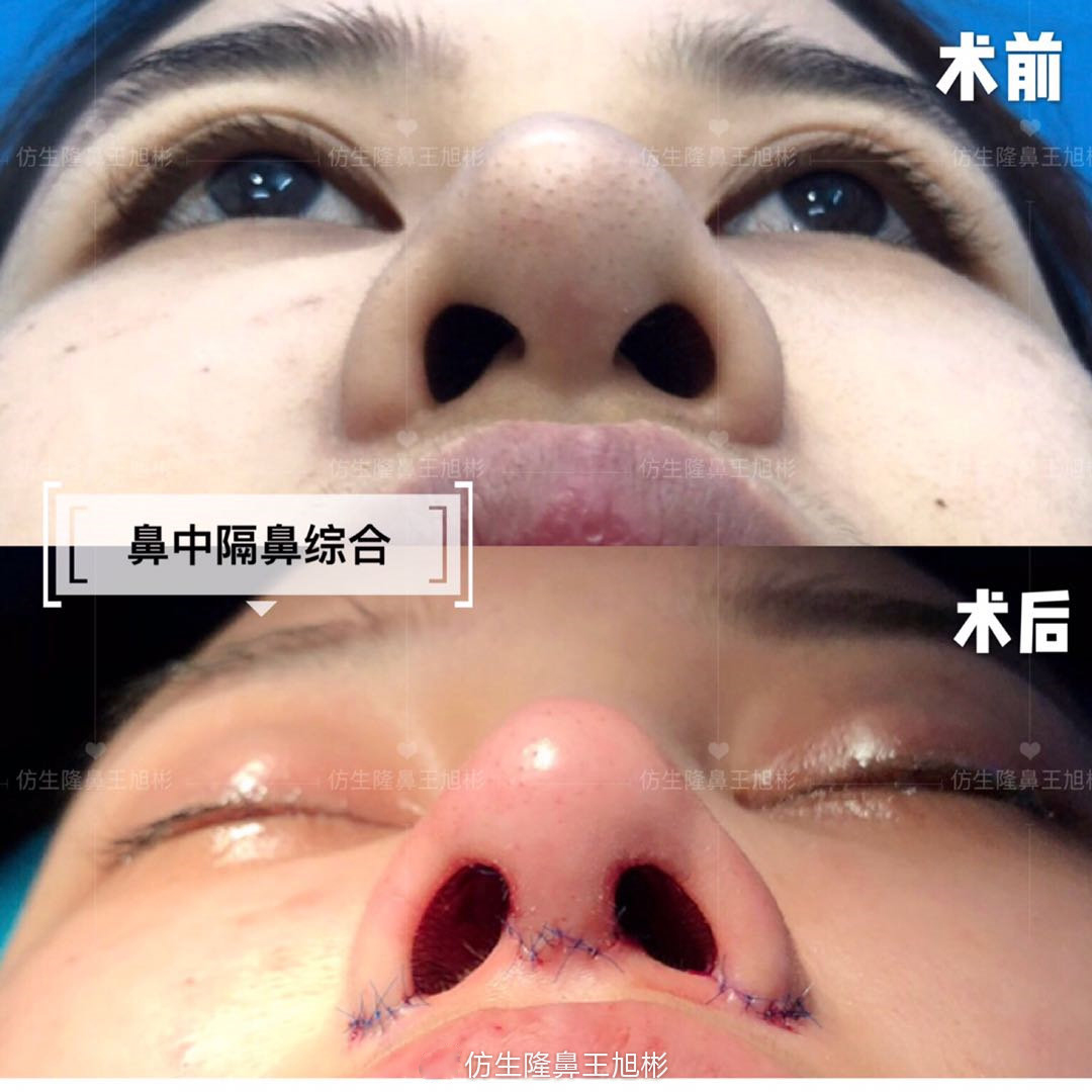 缩鼻翼可以改善鼻翼下垂吗,鼻翼肥大之鼻翼缩小术你见过吗