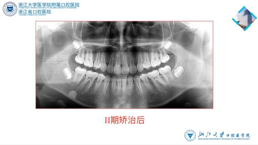 儿童9岁下颌后缩矫治,高角下颌后缩怎么矫治