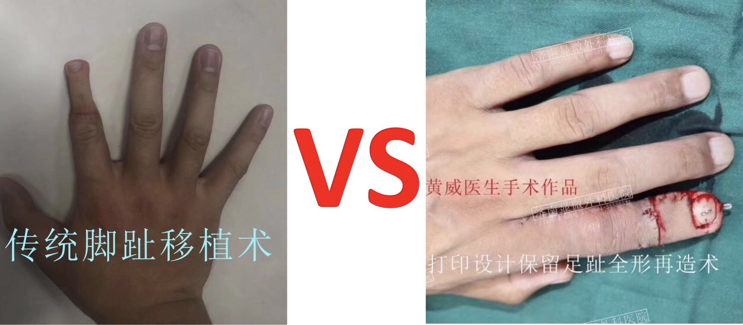 断指再植失败怎么治,断指再植失败后截肢关注什么