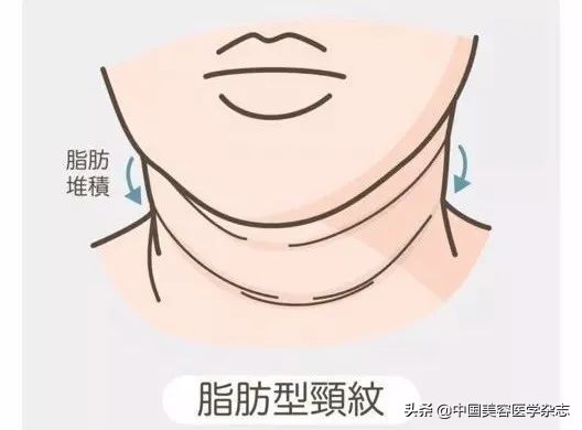 你的脖子比脸更显老，出现颈纹该怎么