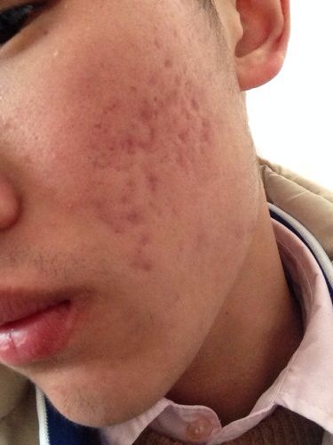 皮肤科医生怎么处理脸上痘痘,如何治疗脸上痘痘和疤痕