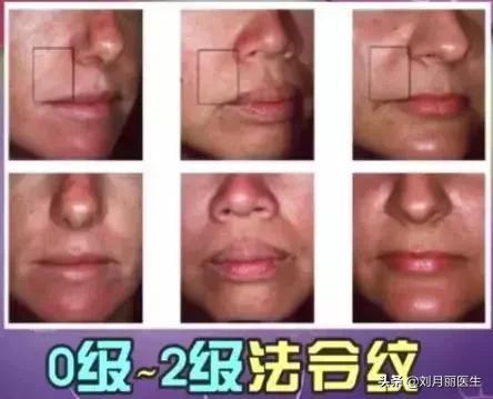 消灭法令纹护肤大法,如何正确嘟嘴消灭法令纹