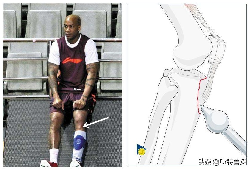 胫骨结节炎和生长痛区别,膝盖胫骨结节痛怎么治