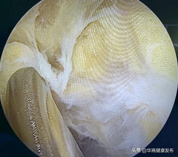 痛风发作在腿弯处有肿块,腿弯出现鸡蛋大肿块是怎么回事