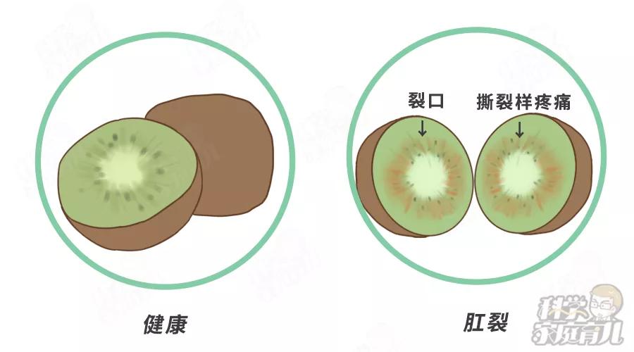 孩子肛裂了便秘不敢拉怎么拉,孩子便秘拉完屎有点肛裂