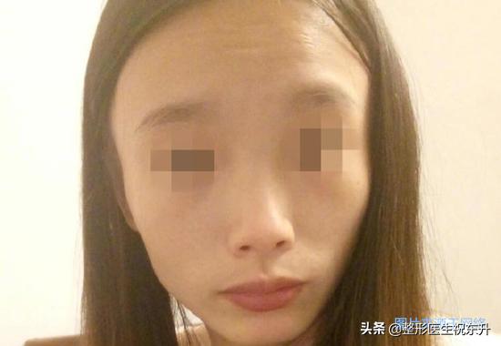 脸不饱满凹陷吃什么,脸大但是脸颊凹陷怎么填充