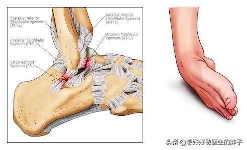 您重视过踝关节扭伤吗？扭伤3个月还不好，我们应该做点什么呢？