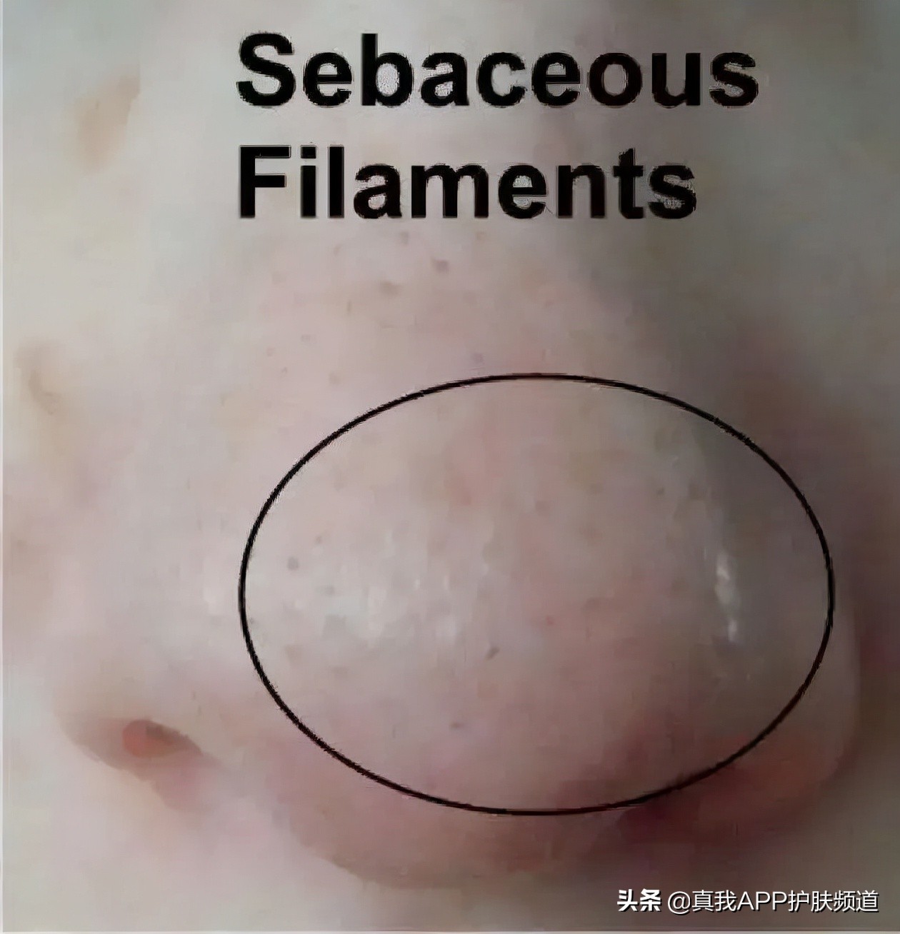 强效去黑头方法,去黑头大科普教你正确去黑头