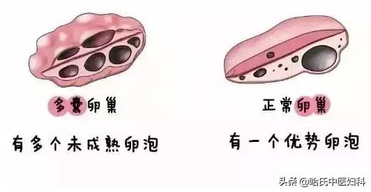 为什么好多年轻女性多囊,多囊女孩怎么回事
