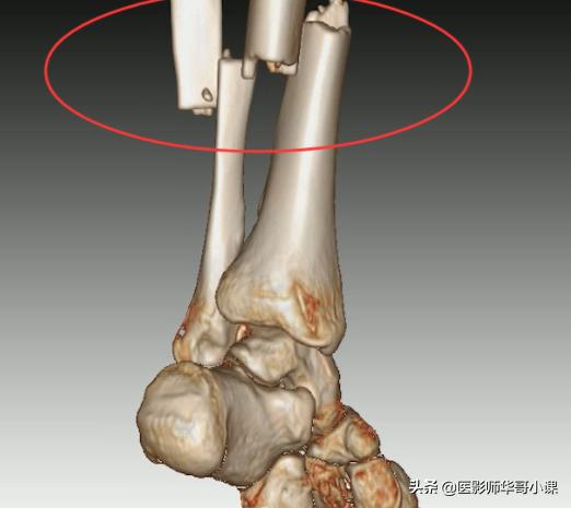 扭伤脚有必要去医院拍片吗,扭伤脚要去哪里看