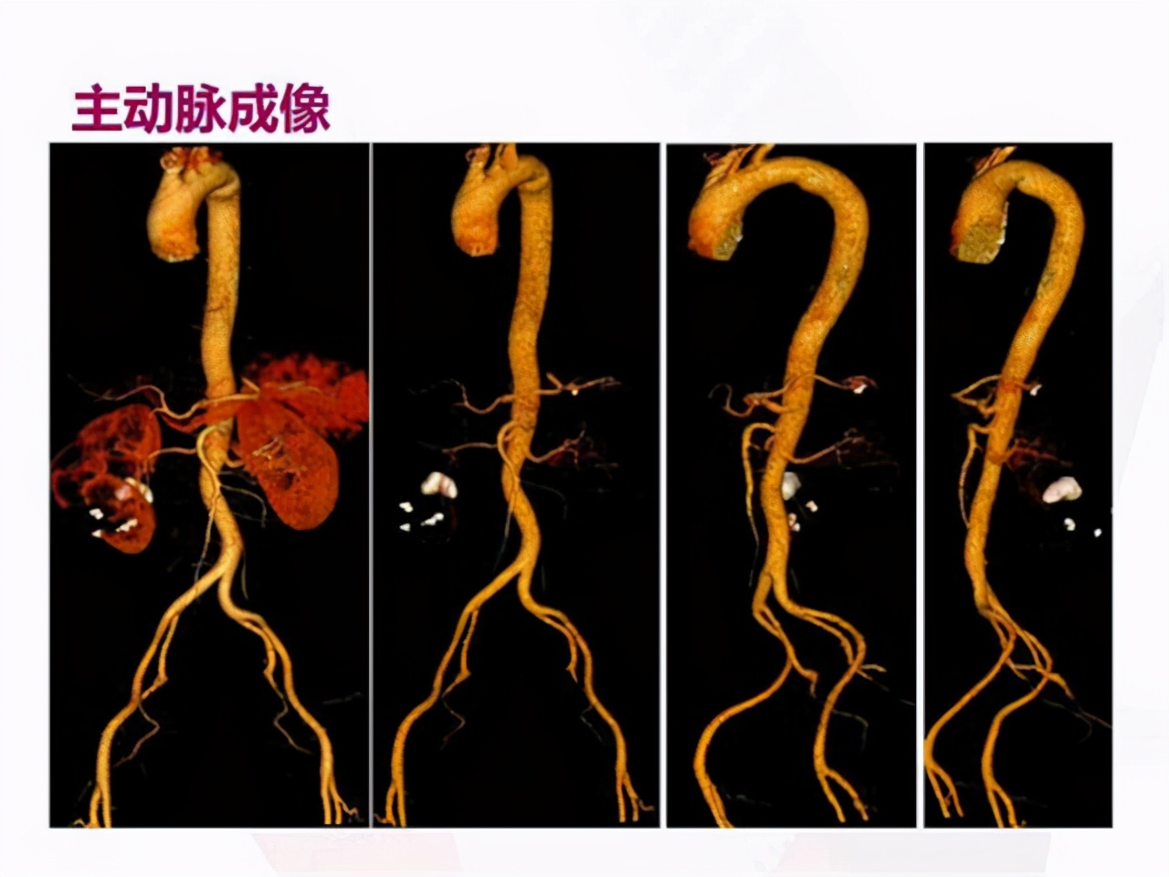 血管里面长瘤严重吗,血管里有肿瘤会发展成恶性的吗