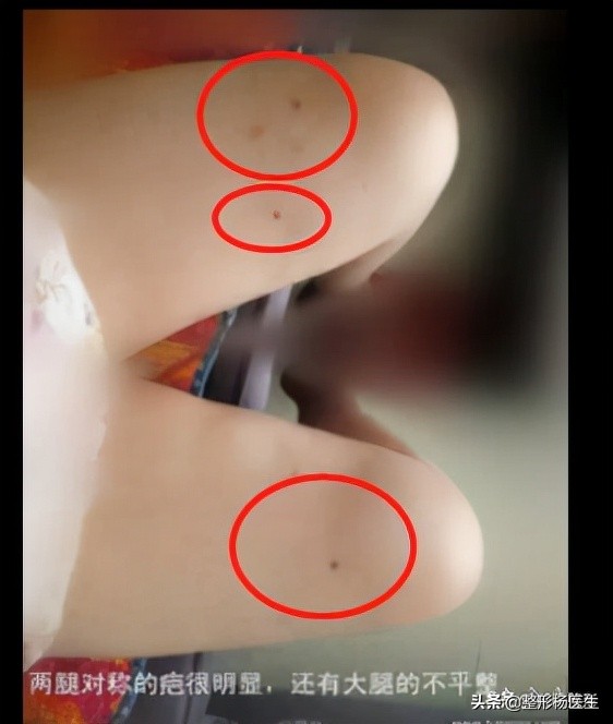 20岁面部凹陷如何改善,脂肪填充面部凹陷怎么导致的呢