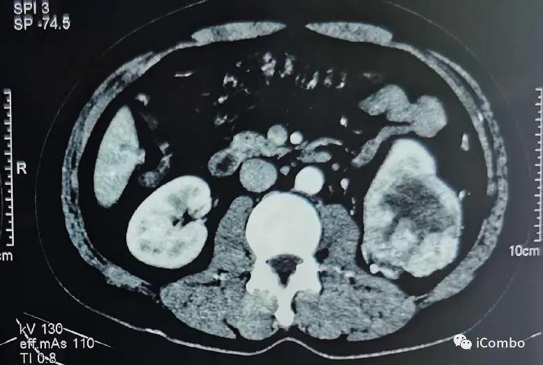 肾癌369例临床分析,恶性肾癌中晚期治疗方案