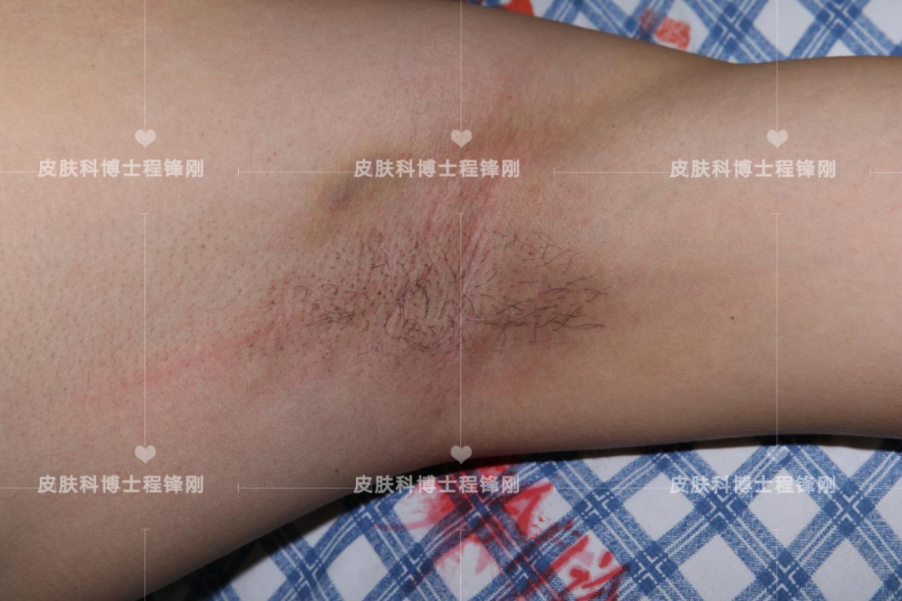 十七岁同学有遗传腋臭最好办法,男性有狐臭后代遗传的概率多大