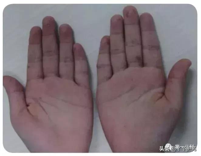 麻疹水痘猩红热手足口病区别,猩红热手足口病怎么治