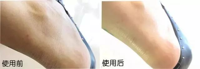 冬季手脚干裂用什么方法,冬天手脚干燥裂口针灸