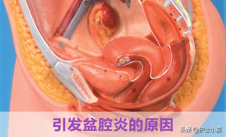 女人得了盆腔炎症该关注哪些,盆腔炎怎么预防和改善
