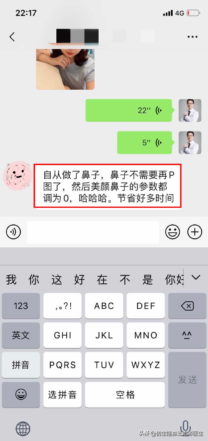 鼻头肥大矫正加鼻翼缩窄案例,鼻头缩小术后