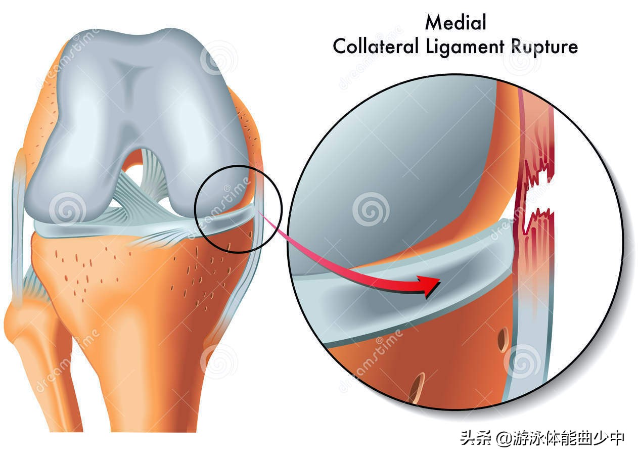 游泳膝关节疼痛,游泳导致膝盖内侧疼痛怎么解决