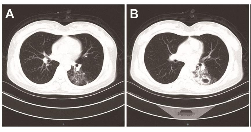 肺结核病史孕妇感染新冠肺炎,孕妇感染新冠胎儿白肺