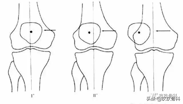 膝盖疼原来是腿向跑偏,膝盖走不准就疼一下是咋回事