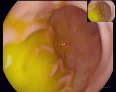 胆囊把胆汁输送到哪里,胆囊炎和胃病胆汁反流有区别吗