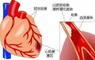 32岁北大博士心梗猝死,知名医生突发心梗