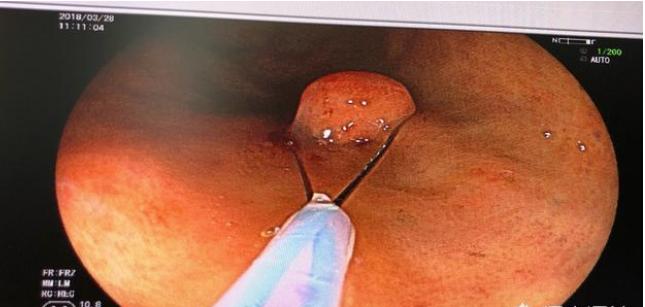 肠镜切息肉需要麻醉吗,肠镜中发现息肉是在手术中切除吗